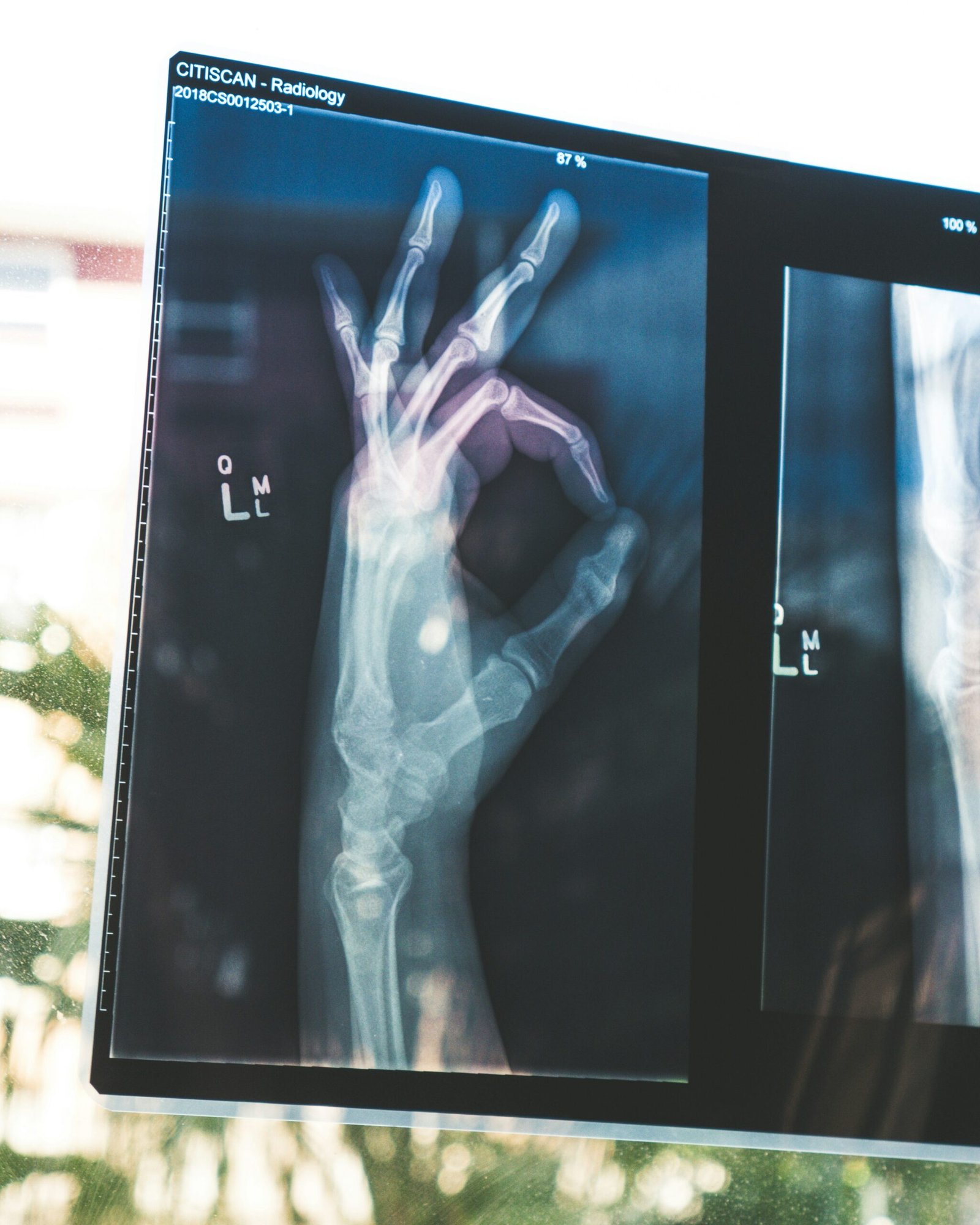 Understanding Osteoporosis: Causes, Risk Factors, Symptoms, and Prevention Strategies